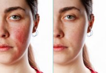 How to Get Rid of Rosacea: 7 Rosacea Remedies That Work