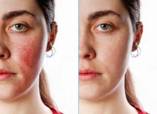 How to Get Rid of Rosacea: 7 Rosacea Remedies That Work