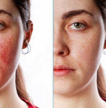 How to Get Rid of Rosacea: 7 Rosacea Remedies That Work