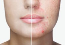 How to Get Rid of Acne Scars: 10 Products and Remedies to Try