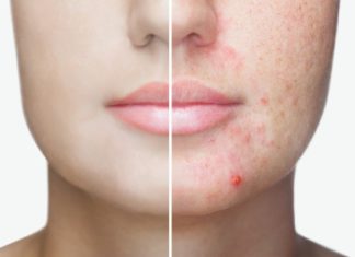 How to Get Rid of Acne Scars: 10 Products and Remedies to Try