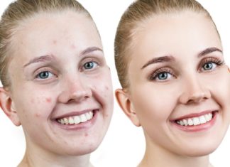 How to Get Rid of Acne Overnight: 12 Remedies that Work