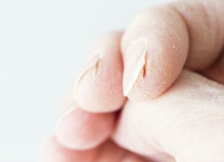 Severely Cracked Hands? 8 Tips & Remedies for Fast Relief
