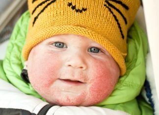 Natural eczema treatment: 7 natural ways to treat eczema that work!