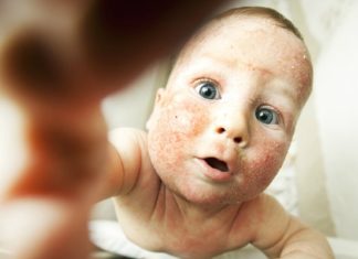 7 eczema remedies that work