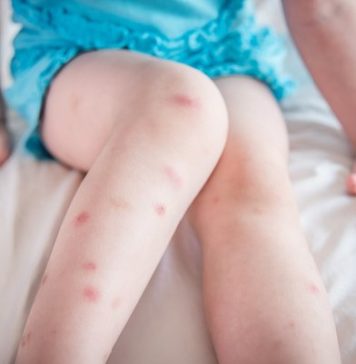 Stop The Itch! 9 Natural Mosquito Bite Remedies that Work