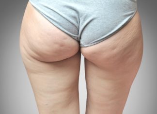 7 Proven Ways to Get Rid of Cellulite Fast For a Sexy Body