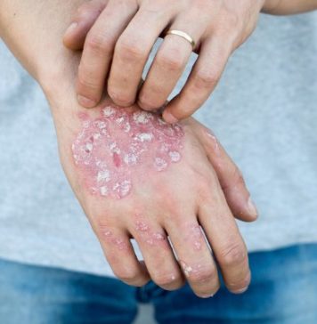 How to Get Rid of Psoriasis: 9 Tips and Remedies to Try
