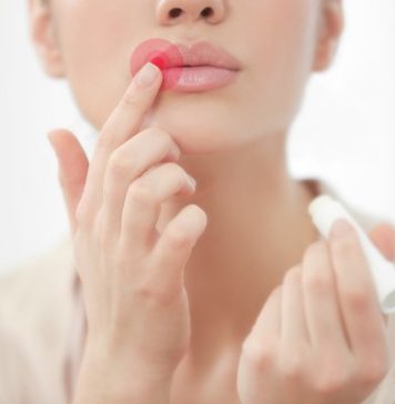 Fast and Effective: 12 Natural Cold Sore Remedies that Work